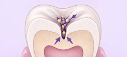 Deep Fissure
